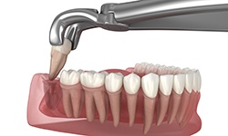 Illustration of forceps being used to extract a tooth