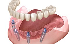 Illustration showing all-on-4 dentures with white background