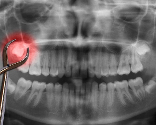 X-ray showing wisdom tooth glowing red being grasped by instrument