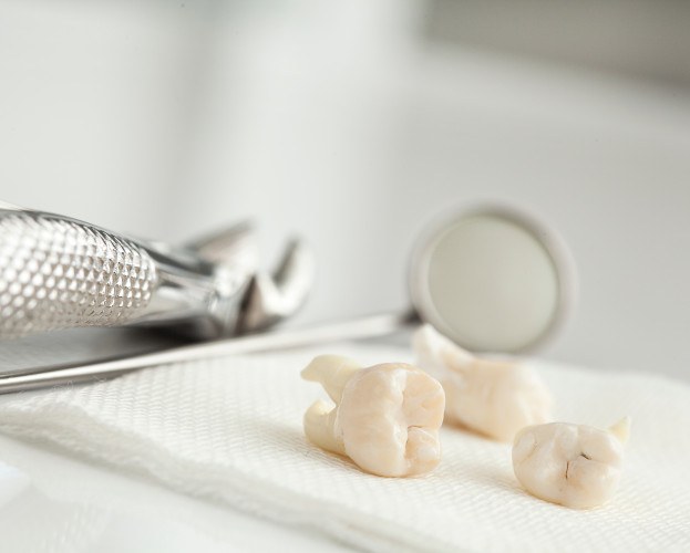 Three extracted molars on a piece of gauze next to forceps and mirror