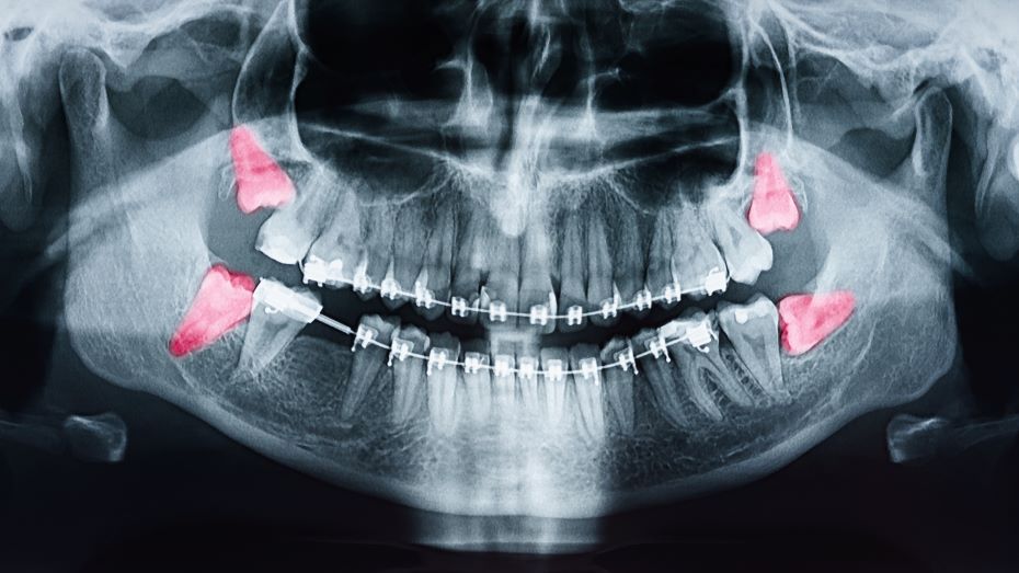 An X-ray of wisdom teeth.